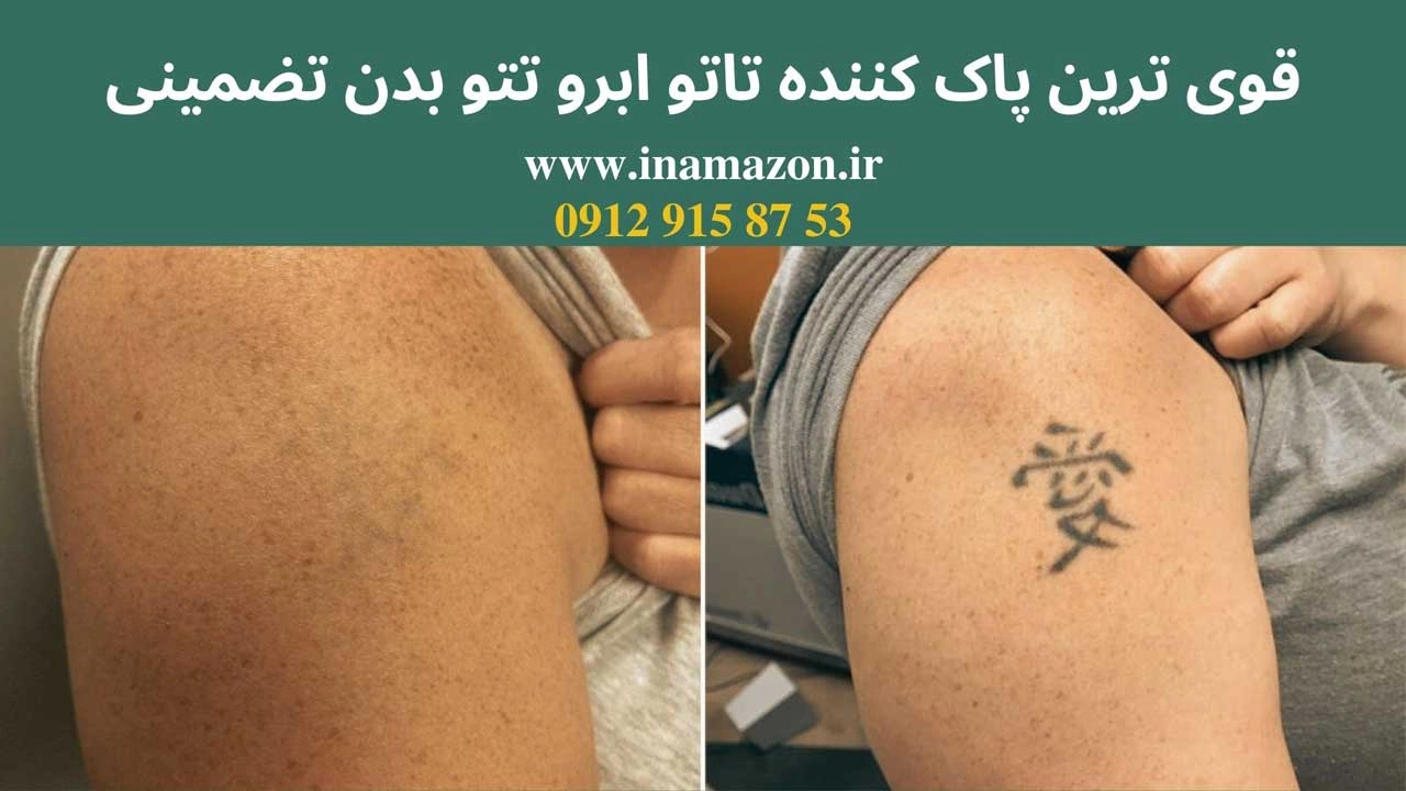 قوی-ترین-پاک-کننده-تاتو-ابرو-تتو-بدن-تضمینی